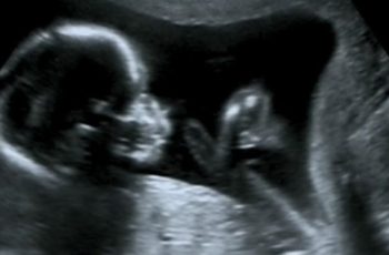 Eco fetal: entenda mais sobre o exame